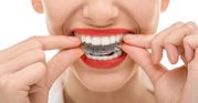 Align your teeth and restore dental functionality with quality braces