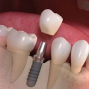 Single Tooth Implants in NYC