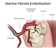 Uterine Fibroids Treatment in Brooklyn