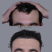 Male Hair Loss Treatments